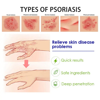 Psoriasis & Sensitive Skin Soothing Cream – Helps Calm Dry, Itchy Skin